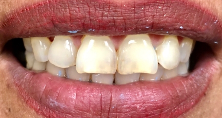 Smile with dark discoloration on top front teeth